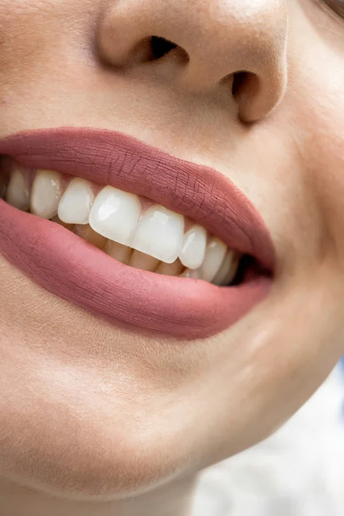Clareamento Dental
