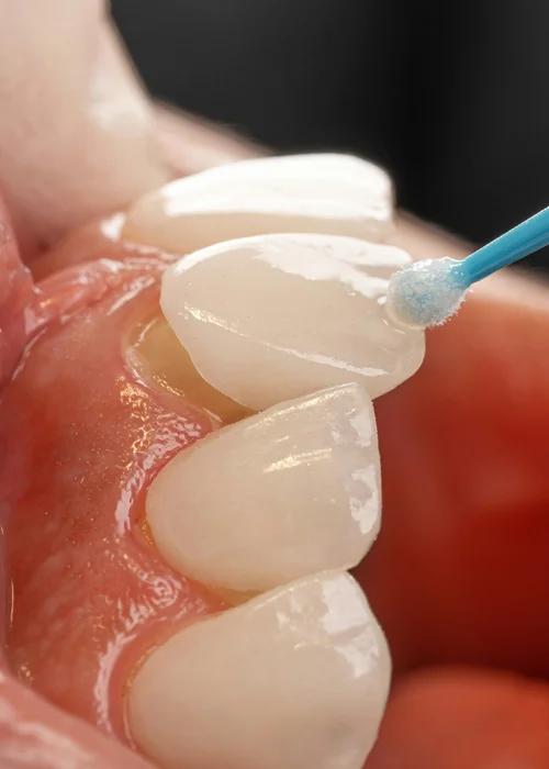 Lentes de Contato Dental