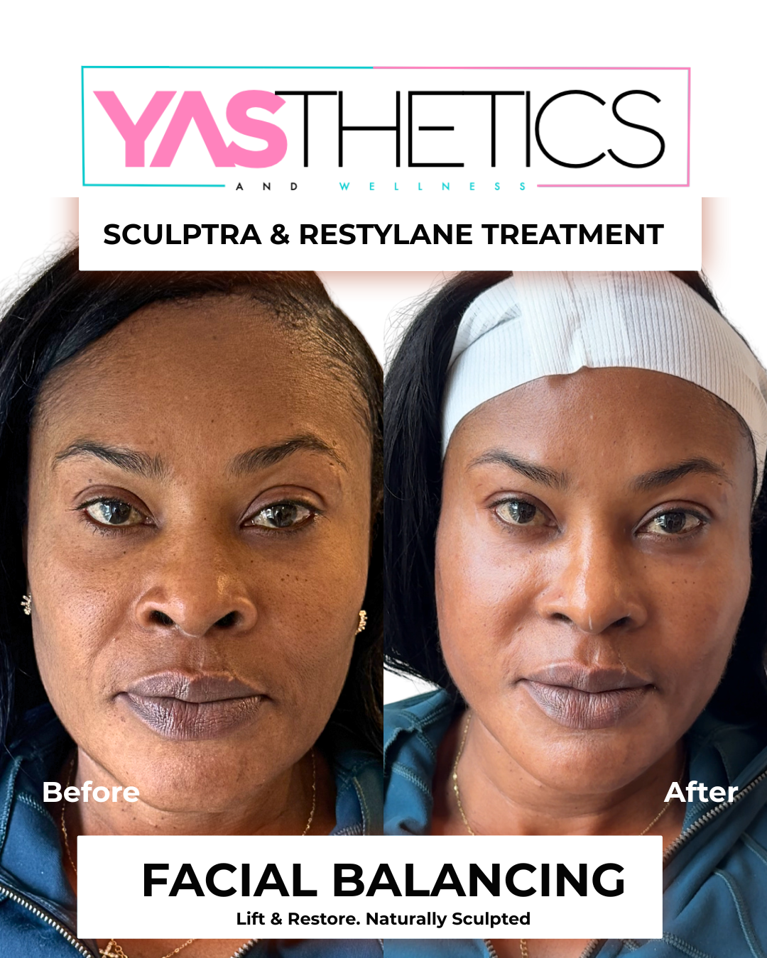 What Is Facial Balancing? How Sculptra and Restylane Work Together to Restore Your Natural Structure