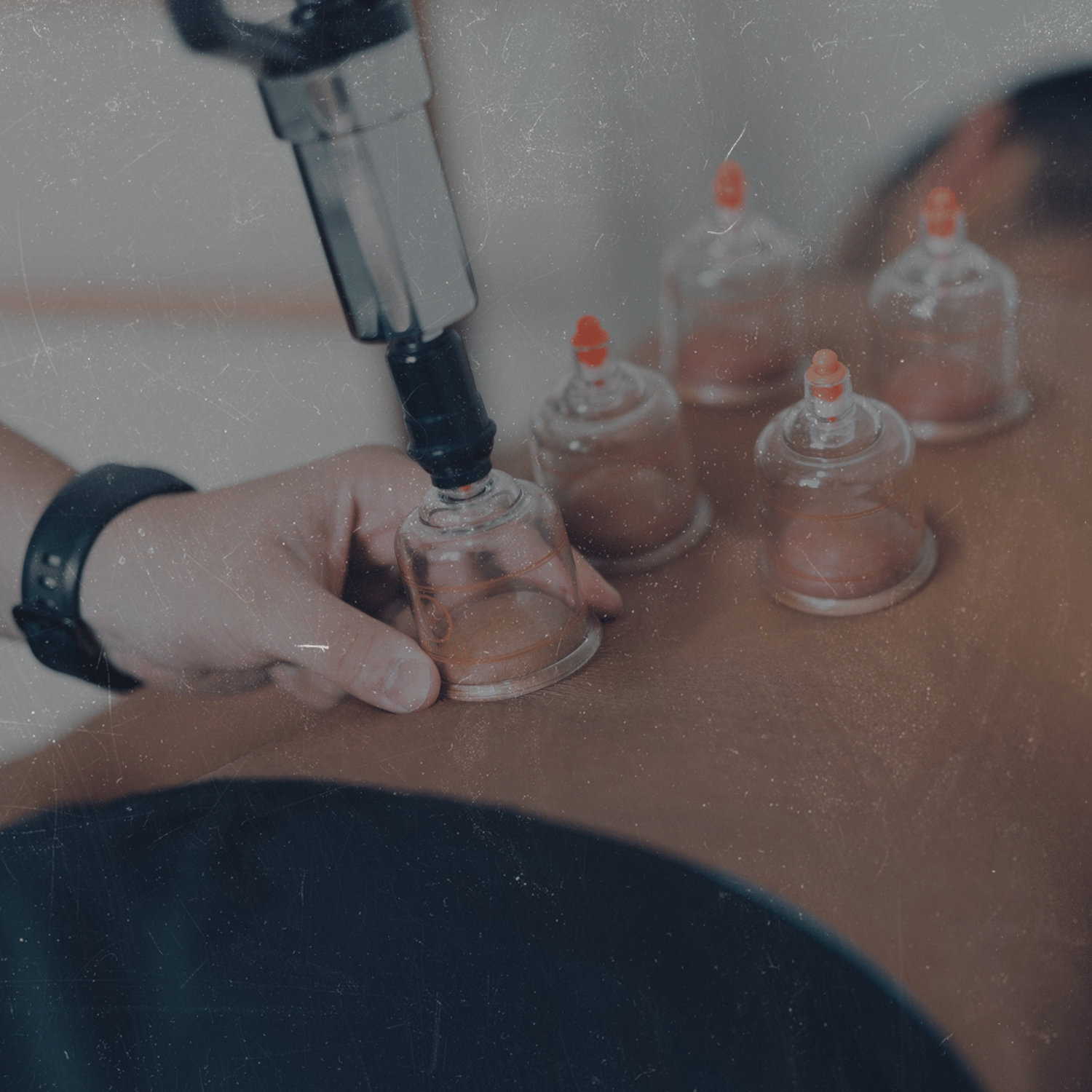 A person receiving an acupuncture treatment with thin needles inserted into their back, while other acupuncture needles are lined up on the patient’s back.