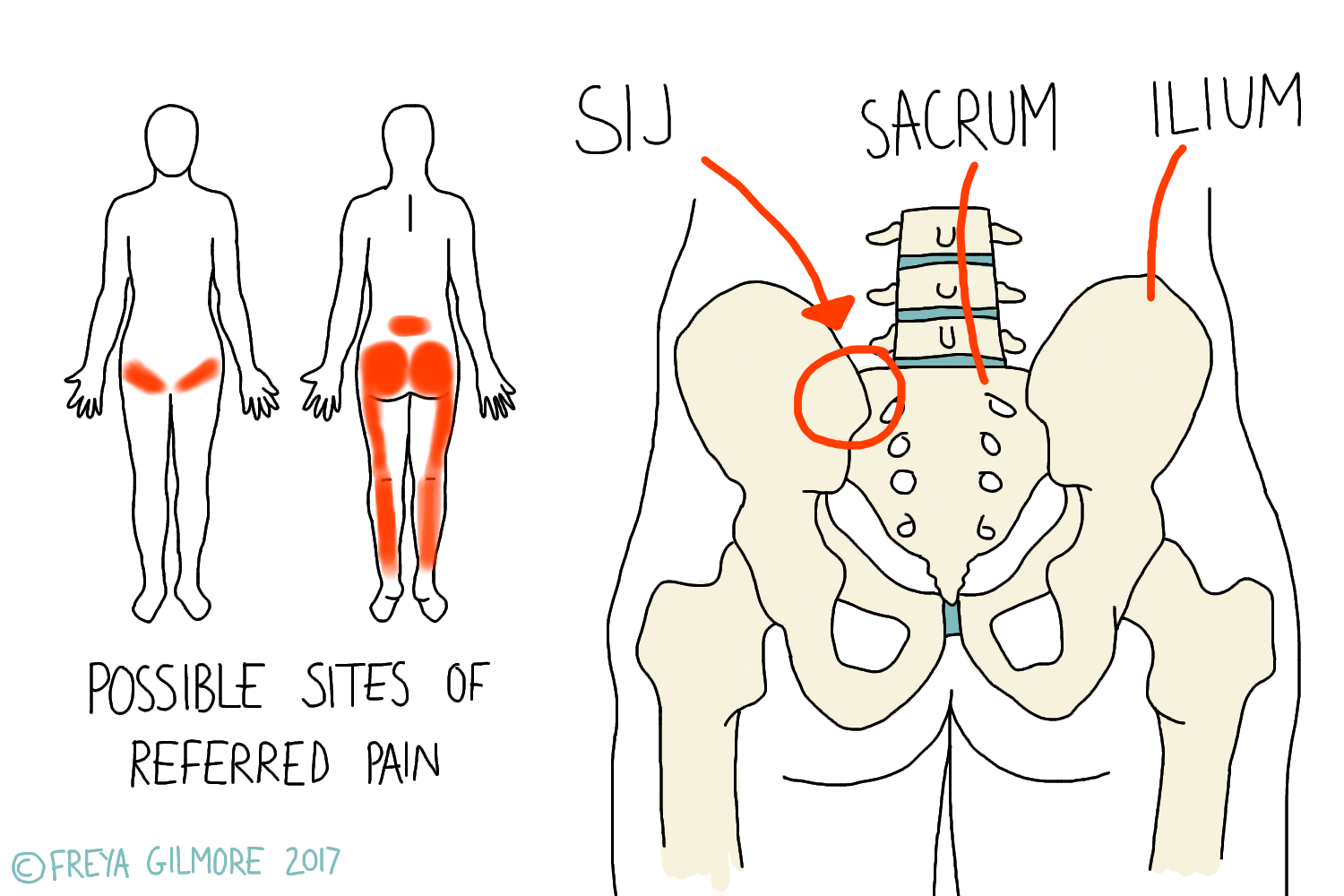 Sacroiliac Joint Dysfunction
