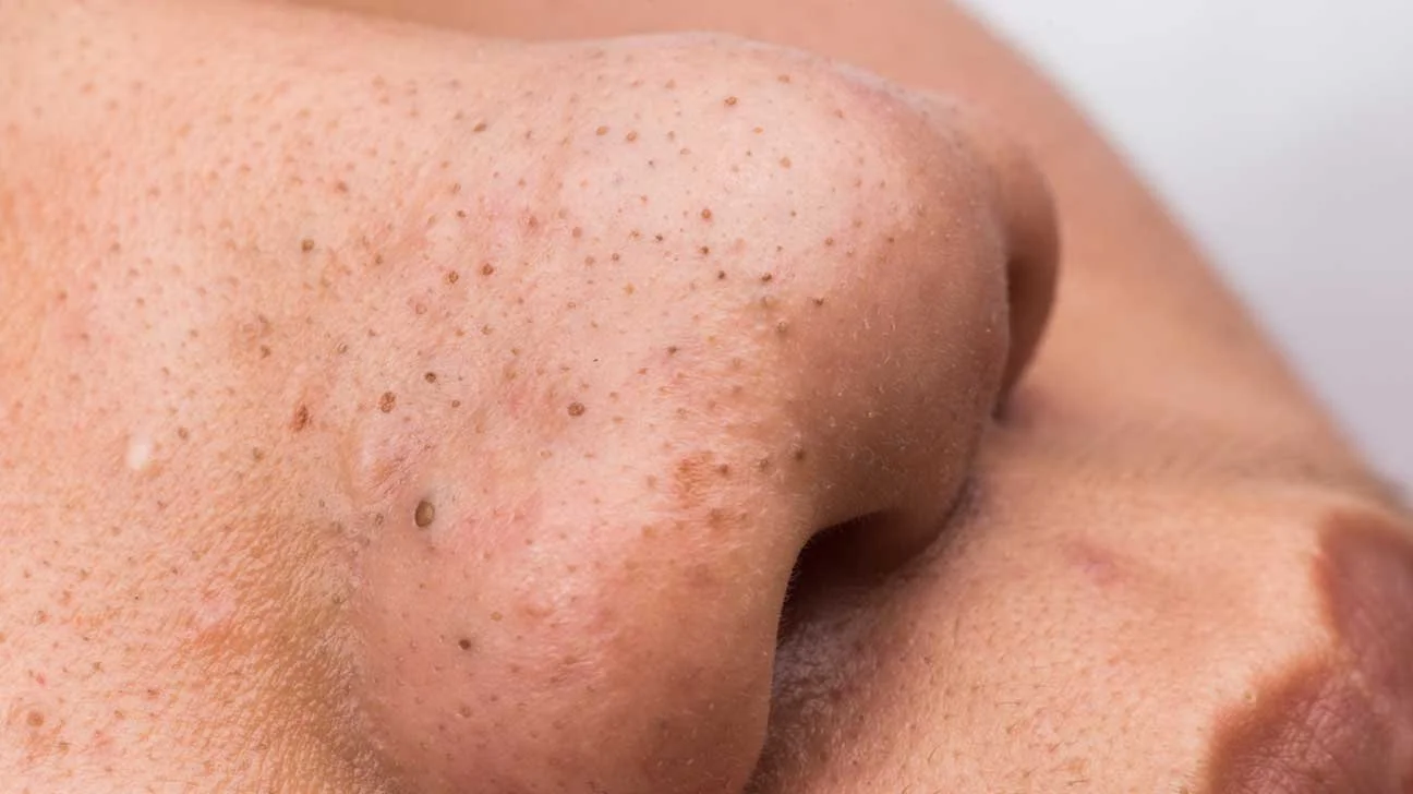 Blackhead treatment