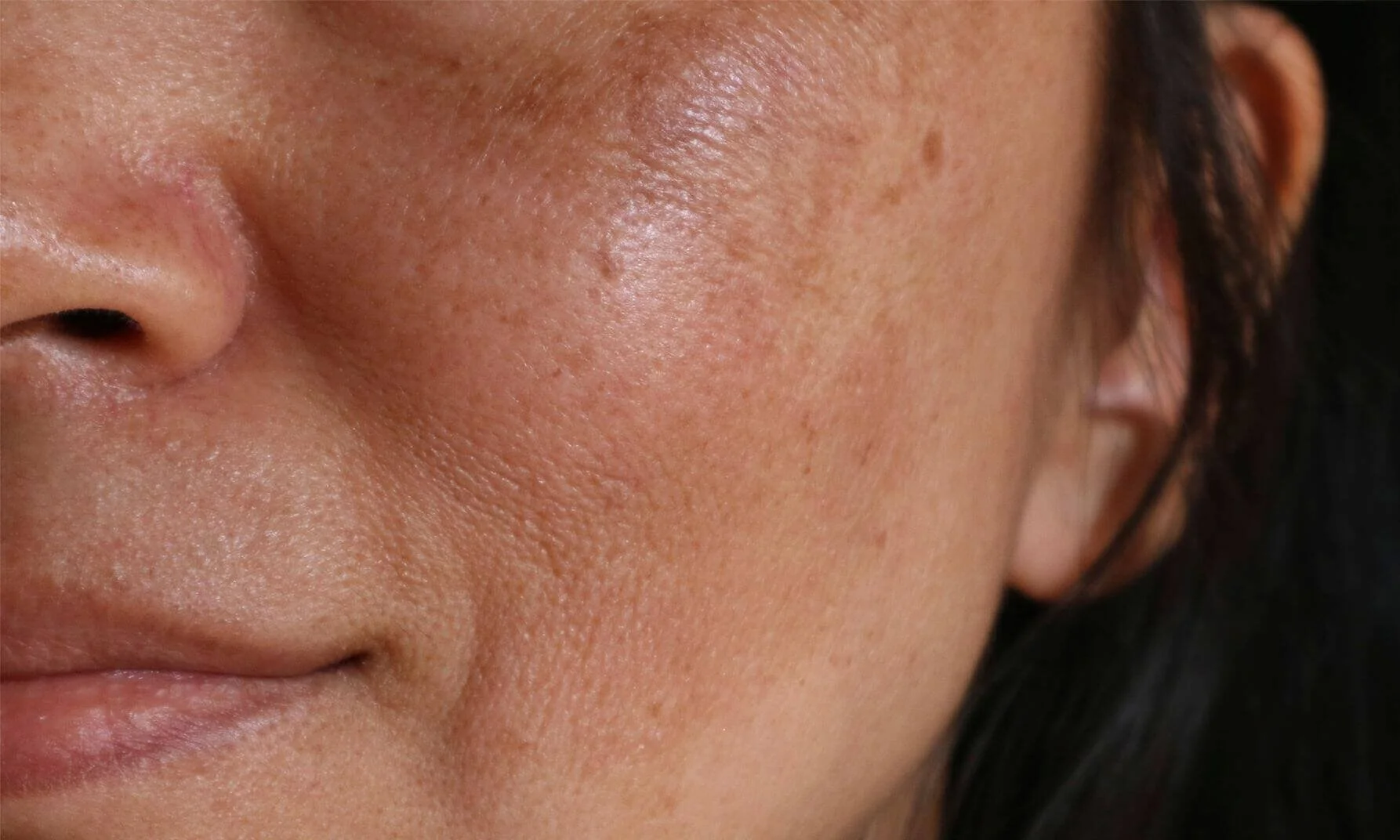 Dark Spots, PIH, or Melasma? How to Treat Each with the Right Ingredients