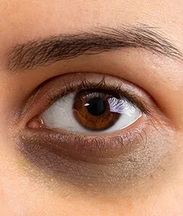 Brownish Circles – Pigmentation &amp; Melanin