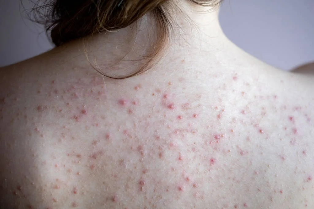 fungal acne on back.jpg