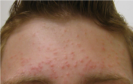fungal acne 3.png