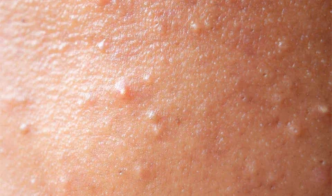 fungal acne2.webp