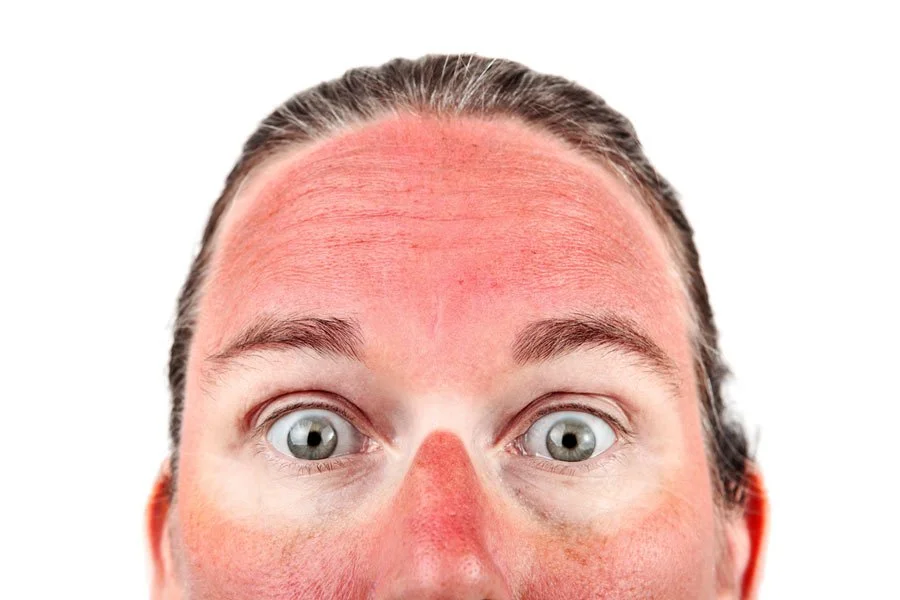 facial sunburn