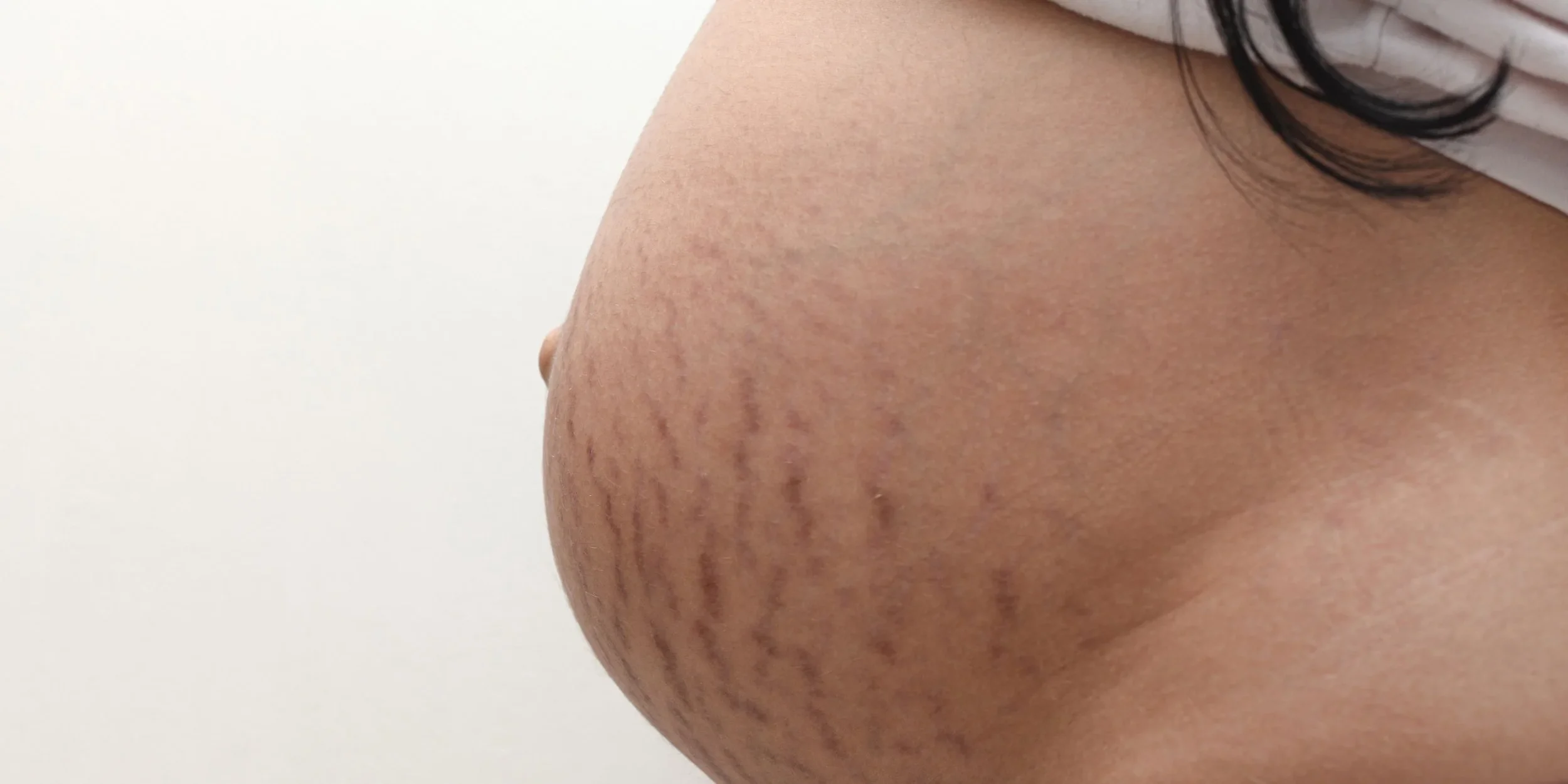 stretch mark during pregnancy