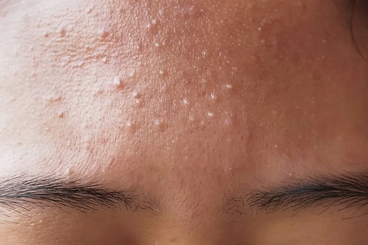 Fungal acne on forehead