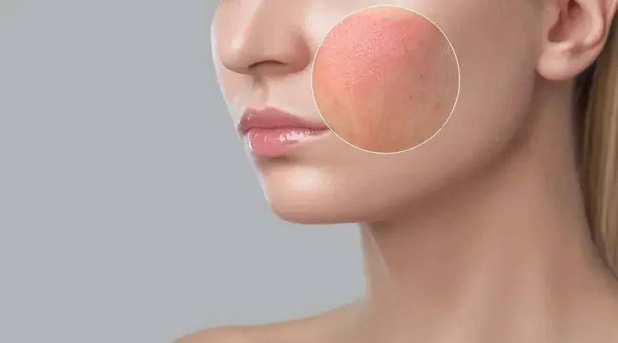 Skin Barrier Repair