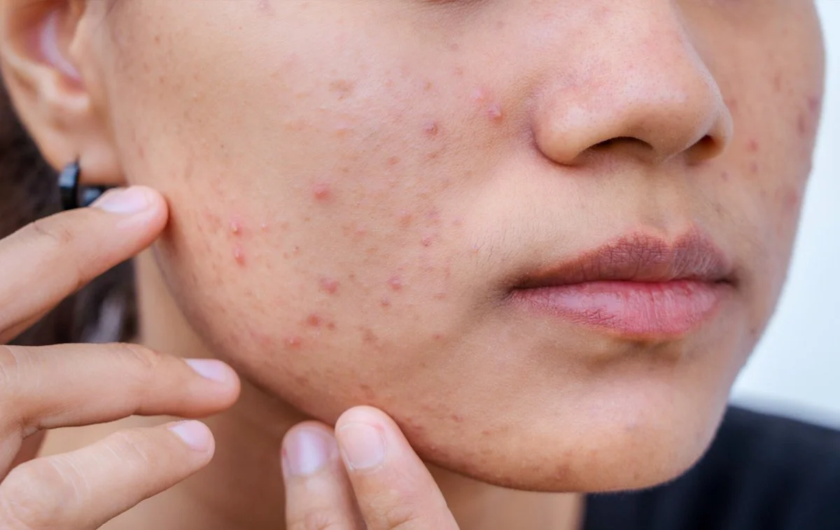 acne prone skin