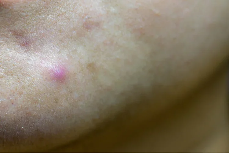 nodular acne
