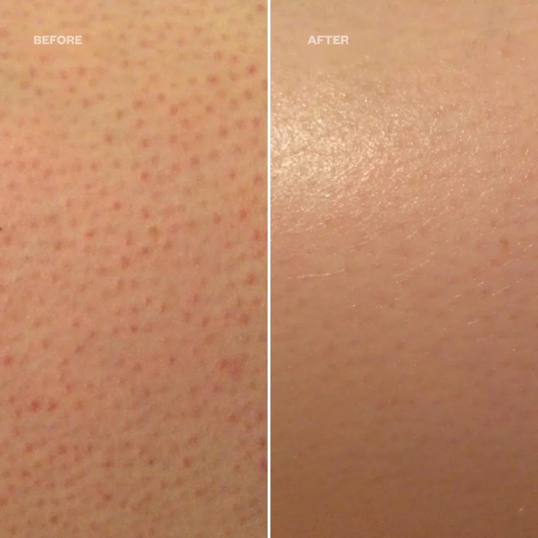 How To Get Rid Of Keratosis Pilaris Strawberry Skin Guide Gabriella How To Get Rid Of Keratosis Pilaris Strawberry Skin Guide Gabriella