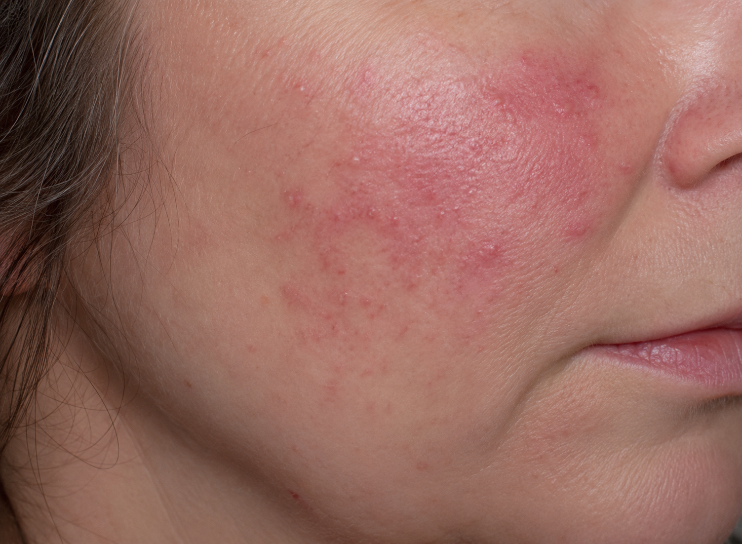 SKIN1004 Azelaic Acid 10 Ampoule