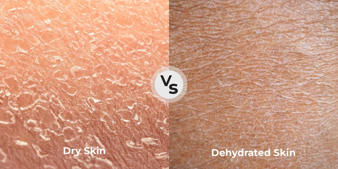Dry Skin vs Dehydrated Skin