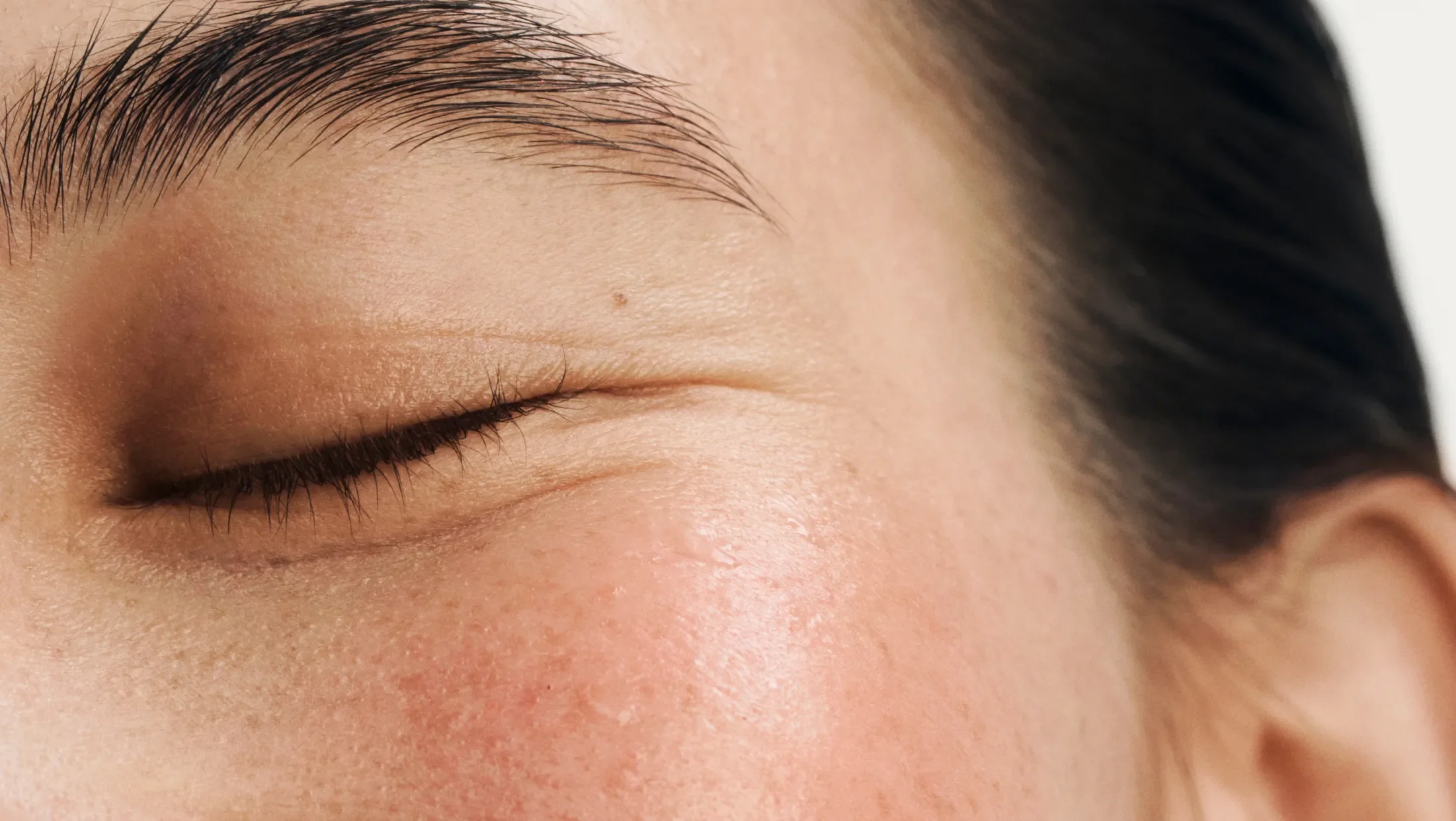 overexfoliated skin