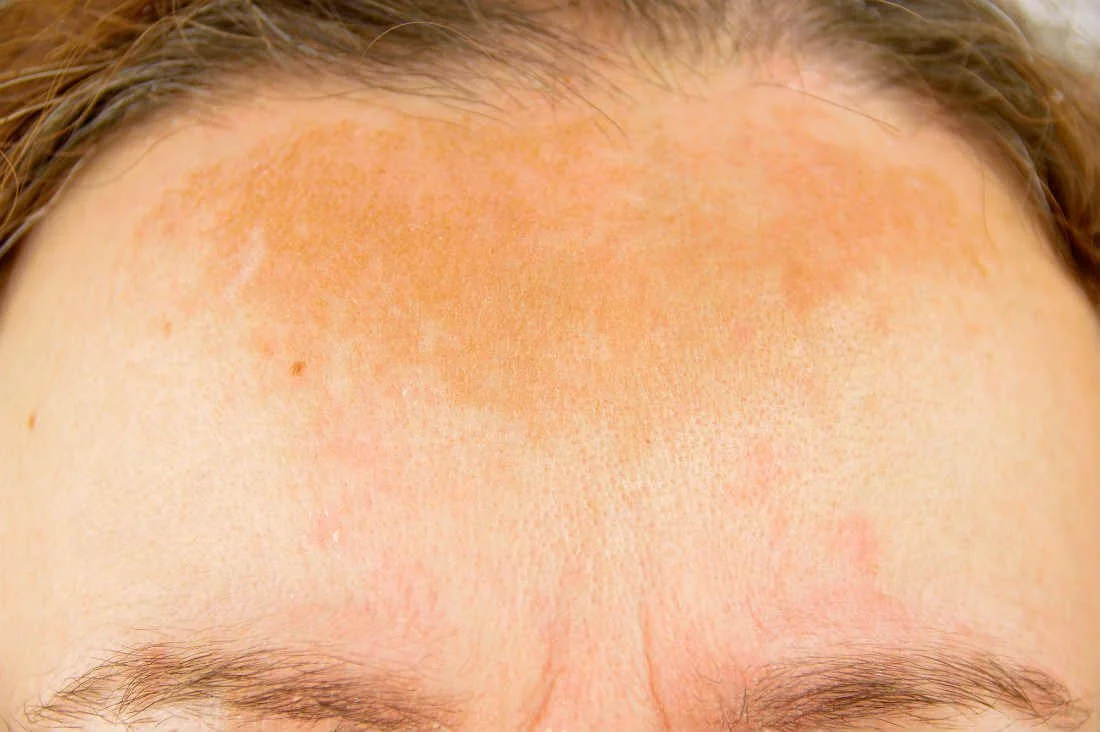 melasma on forehead
