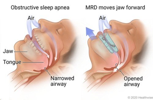Comparison of normal sleep with obstructive sleep apnea showing narrowed and opened airway, and the use of a mandibular repositioning device to move the jaw forward and open the airway.