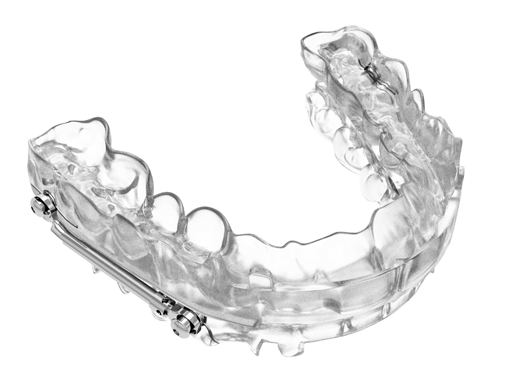 herbst sleep apnea device