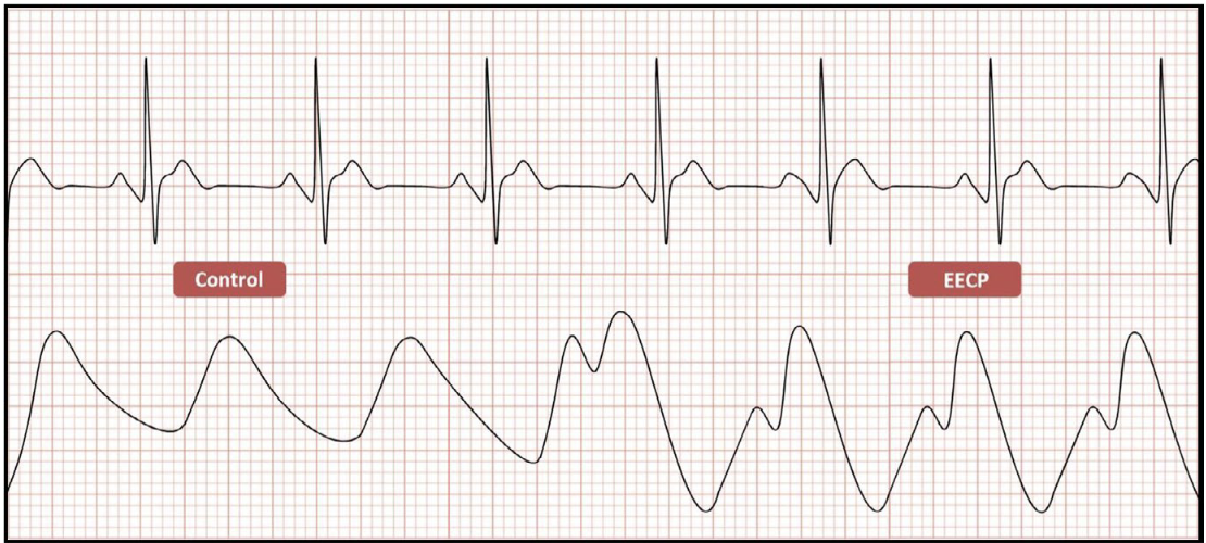 Enhanced external counterpulsation: A unique treatment for the “No-Option” refractory angina patient