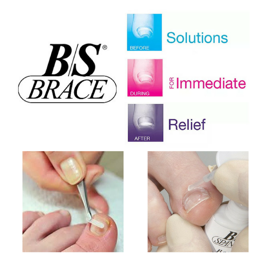 A diagram of a B/S Brace illustrating its use for toenail relief, showing three stages: before, during, and after treatment, with two close-up photos of toenails being treated with the B/S Brace for nail relief.