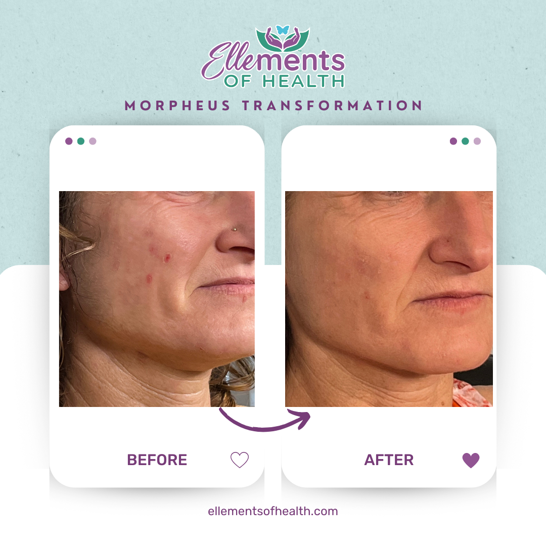 Morpheus 8: Improved complexion, area underneath eye improved, jawline now a beautiful line, and "waddle" under chin is gone. All accomplished with Morpheus 8, naturally. 