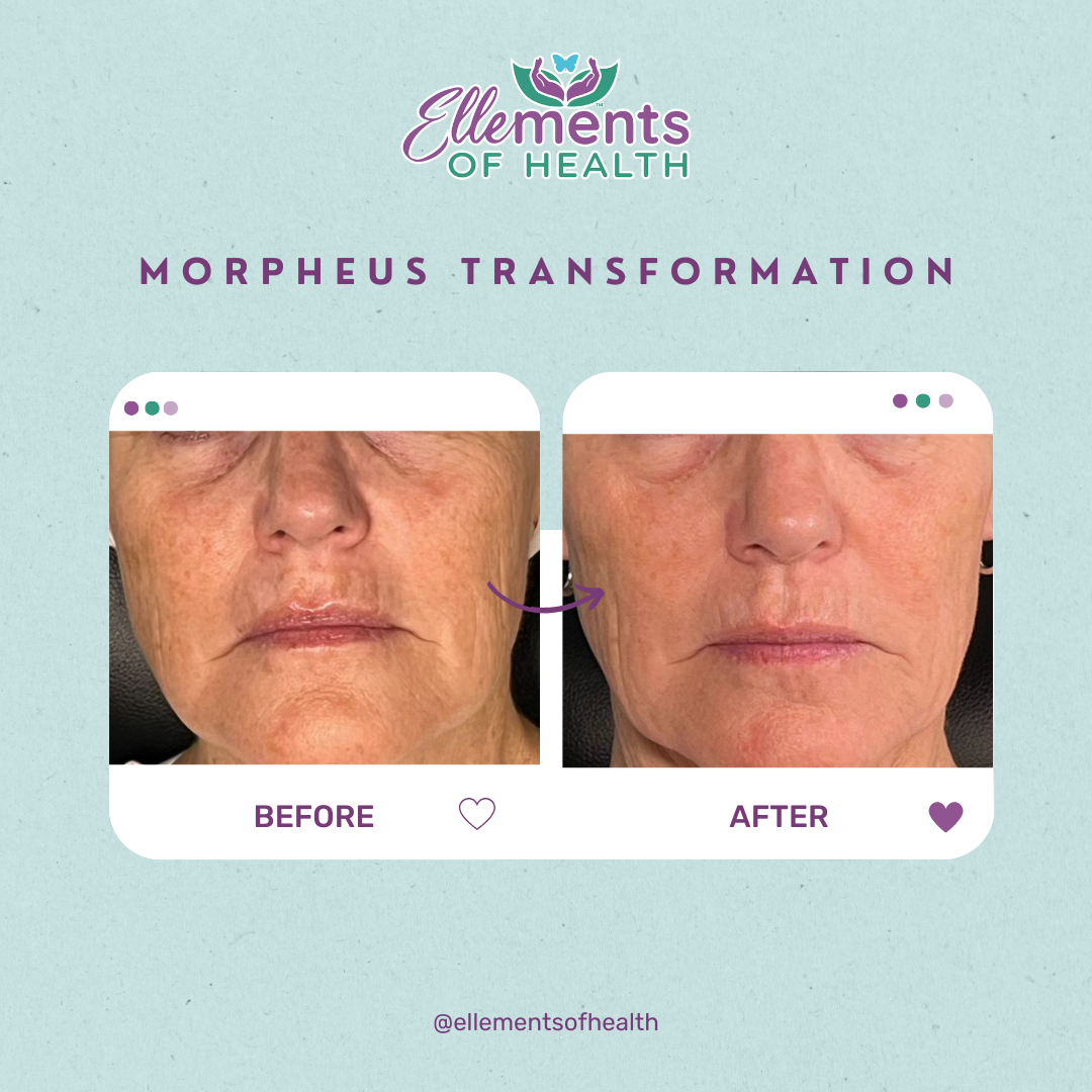 Morpheus 8 takes off 5-10 years, all naturally, and it lasts. 