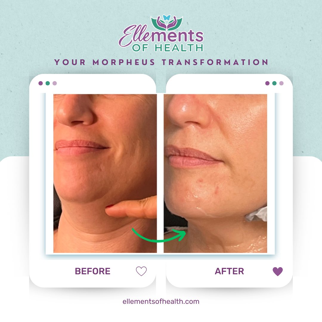 Morpheus 8 fat melting capabilities lets us naturally sculpt face and jawline