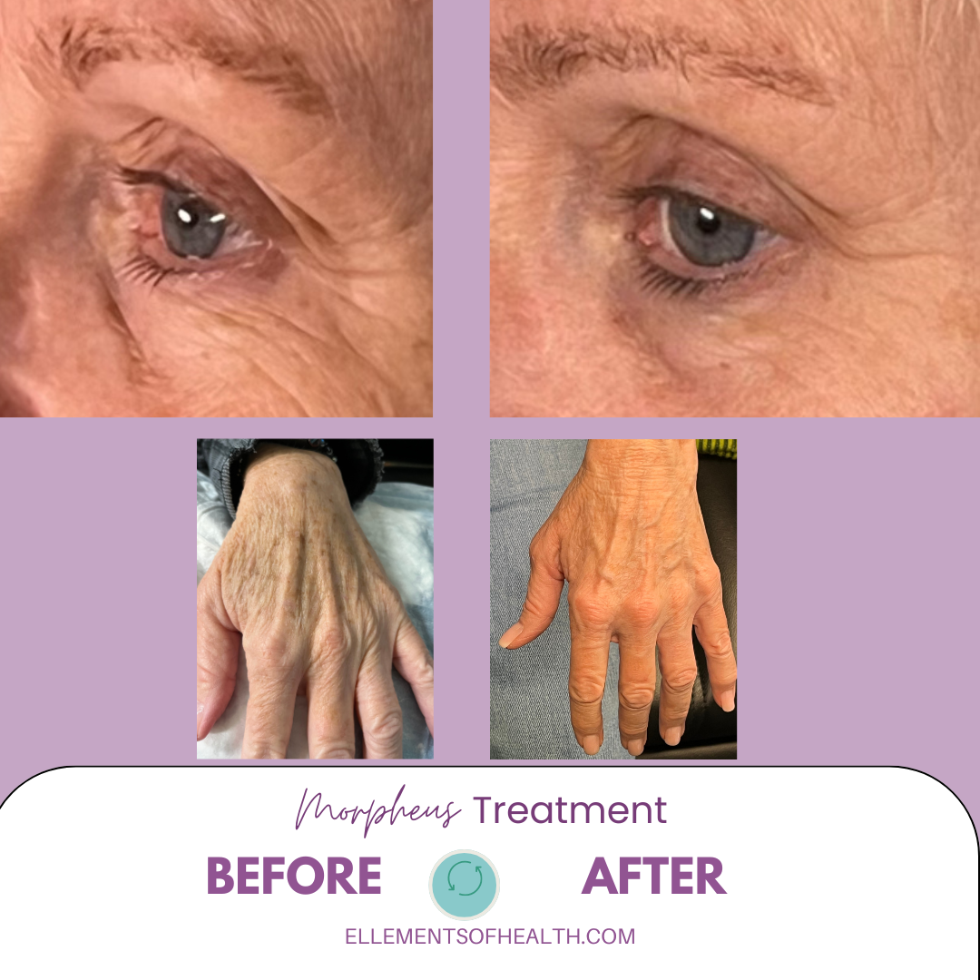 Closeup of eye after Morpheus 8 treatment, and then we had to do her hands with Lumecca IPL to better match the youthful face. 