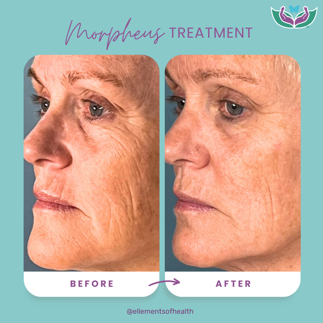 Morpheus 8 reducing wrinkles and more by having the body produce the collagen and rewinding the clock 5-10 years. 