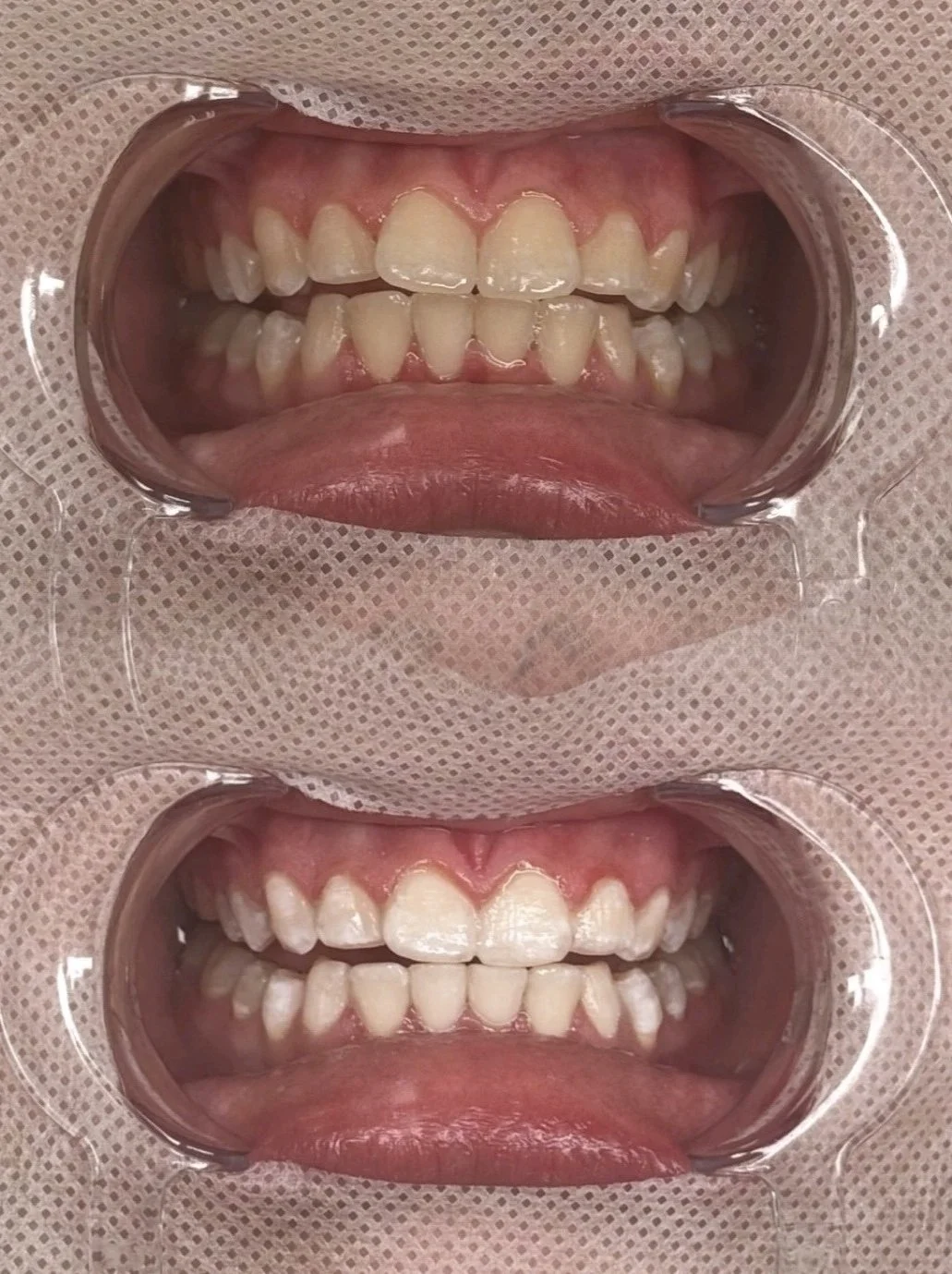 Comparative view of teeth before and after dental treatment, with the top showing more misalignment and the bottom showing improved alignment.