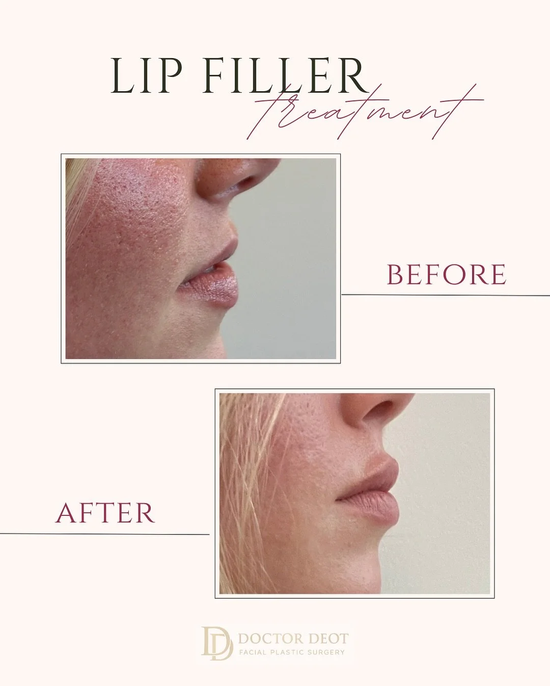 Lip filler isn&rsquo;t just about volume&mdash;it&rsquo;s about structure. The lateral view shows how a subtle lift and defined contour can elevate the entire profile while still looking completely natural. Both results were achieved with just half a