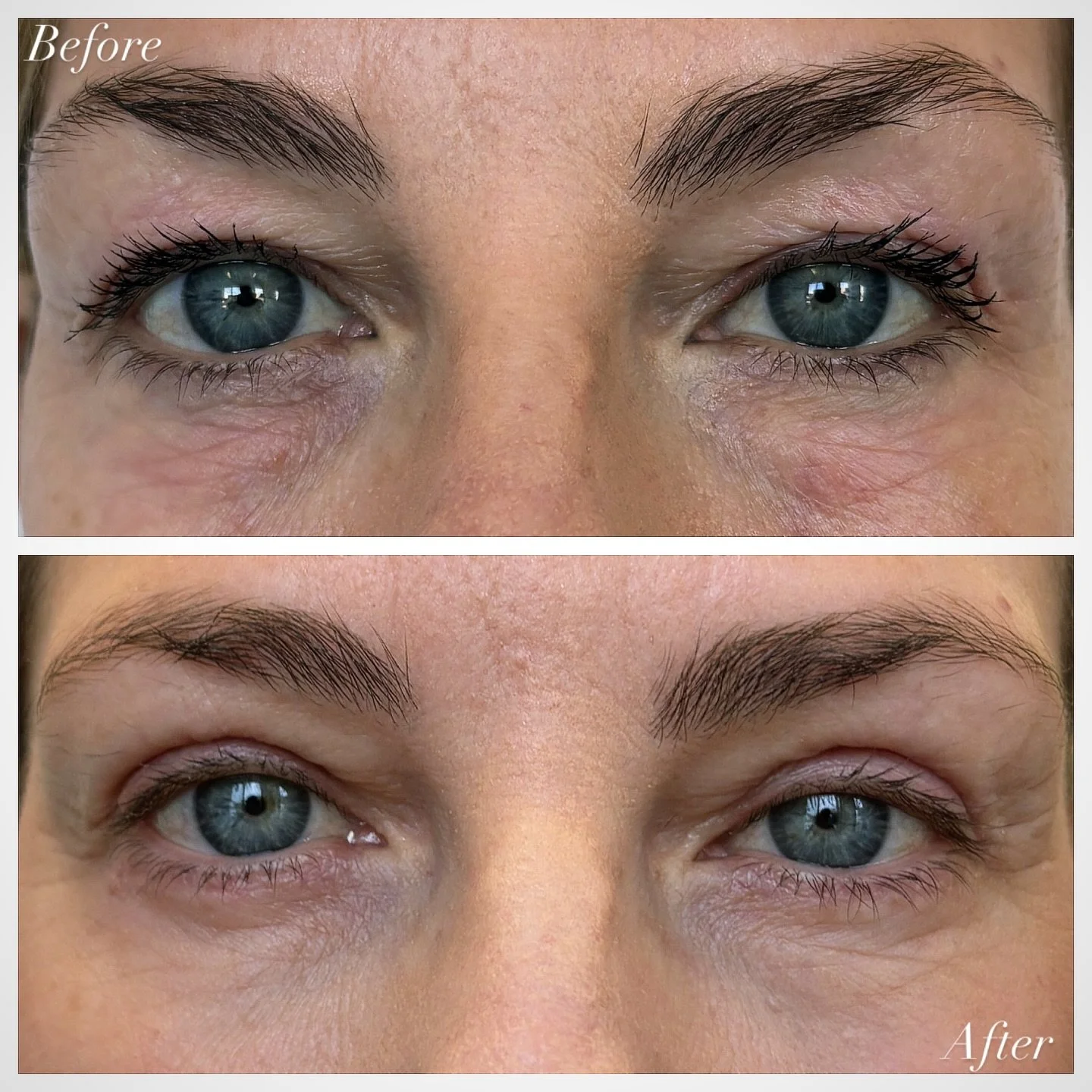 In-Office Upper Bleph &amp; Lower Eyelid Skin Pinch (Post-op 1 Week)

Patients often come in bothered by upper eyelid hooding and skin bunching. An upper blepharoplasty is an elegant solution: through a hidden incision placed in the natural eyelid cr