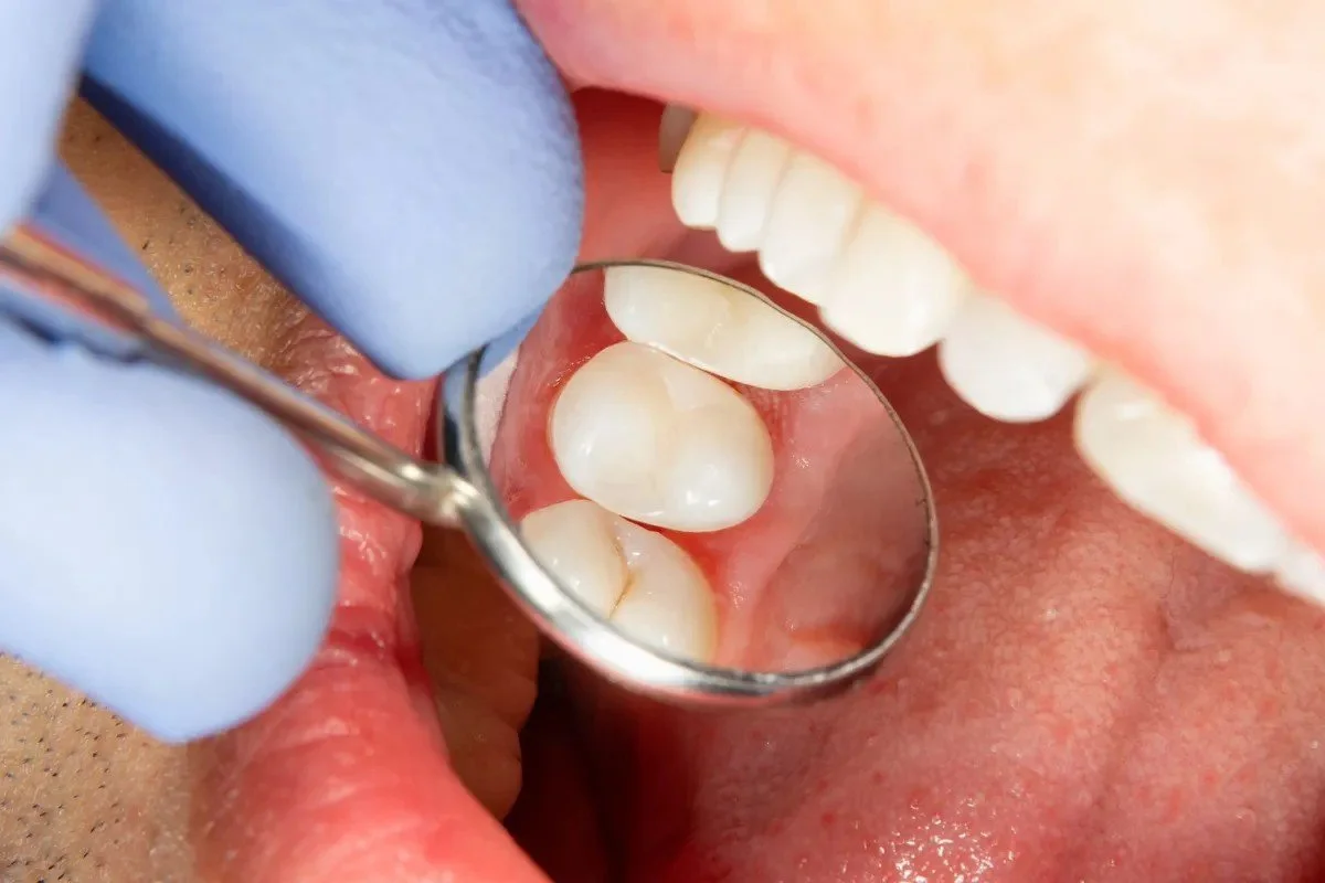 Close-up of a dental examination showing a patient's open mouth reflected in a mirror, with a dentist wearing blue gloves examining the teeth.