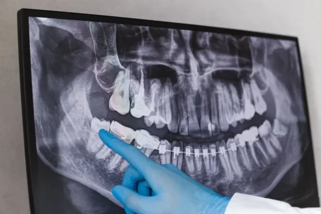Dental X-ray on a monitor showing a person's teeth and jawbone, with a gloved finger pointing at a tooth that shows signs of decay or damage.