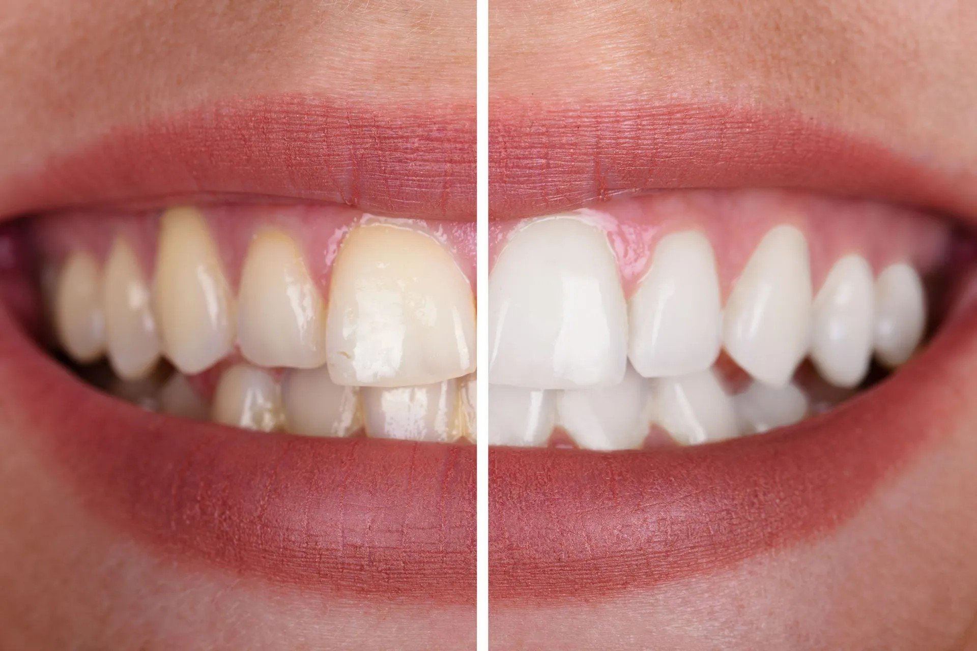 A comparison of teeth before and after whitening. The left side shows discolored teeth, and the right side shows noticeably whiter teeth.