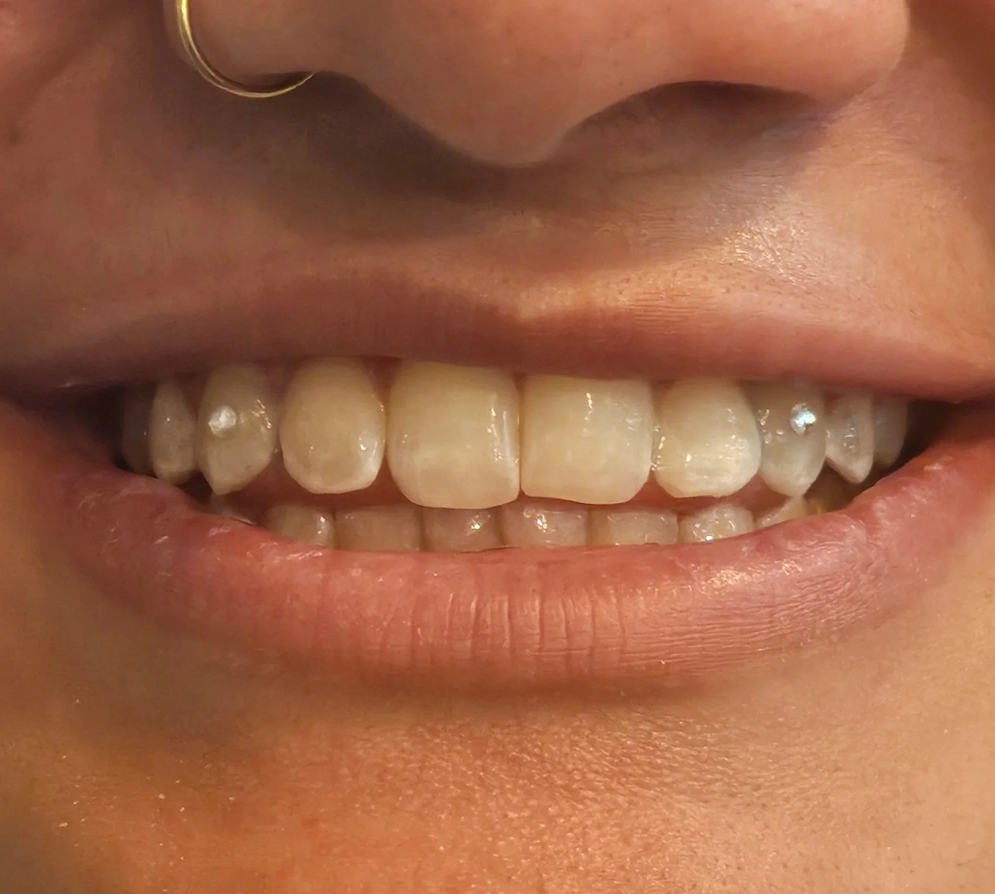 Close-up of a person's smile showing upper and lower teeth.