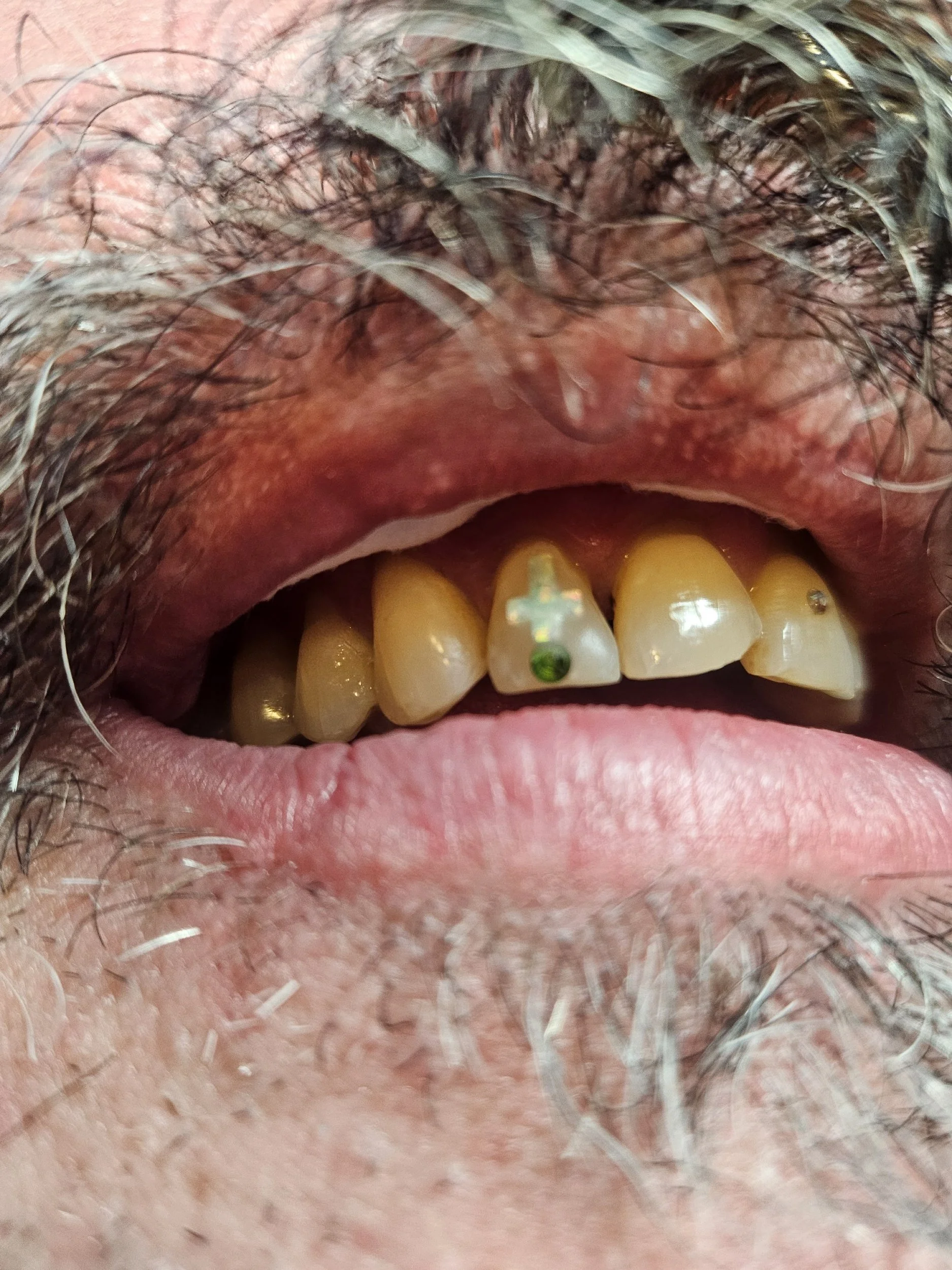 Close-up of a person's open mouth showing yellowed upper teeth, one with a dental implant or crown, surrounded by facial hair and lipstick.