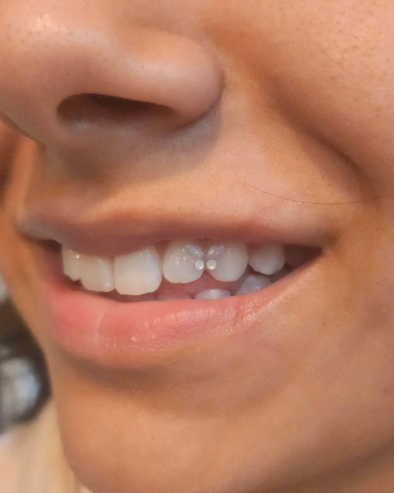 Close-up of a child's smiling mouth showing their front teeth, some of which are growing in or missing.