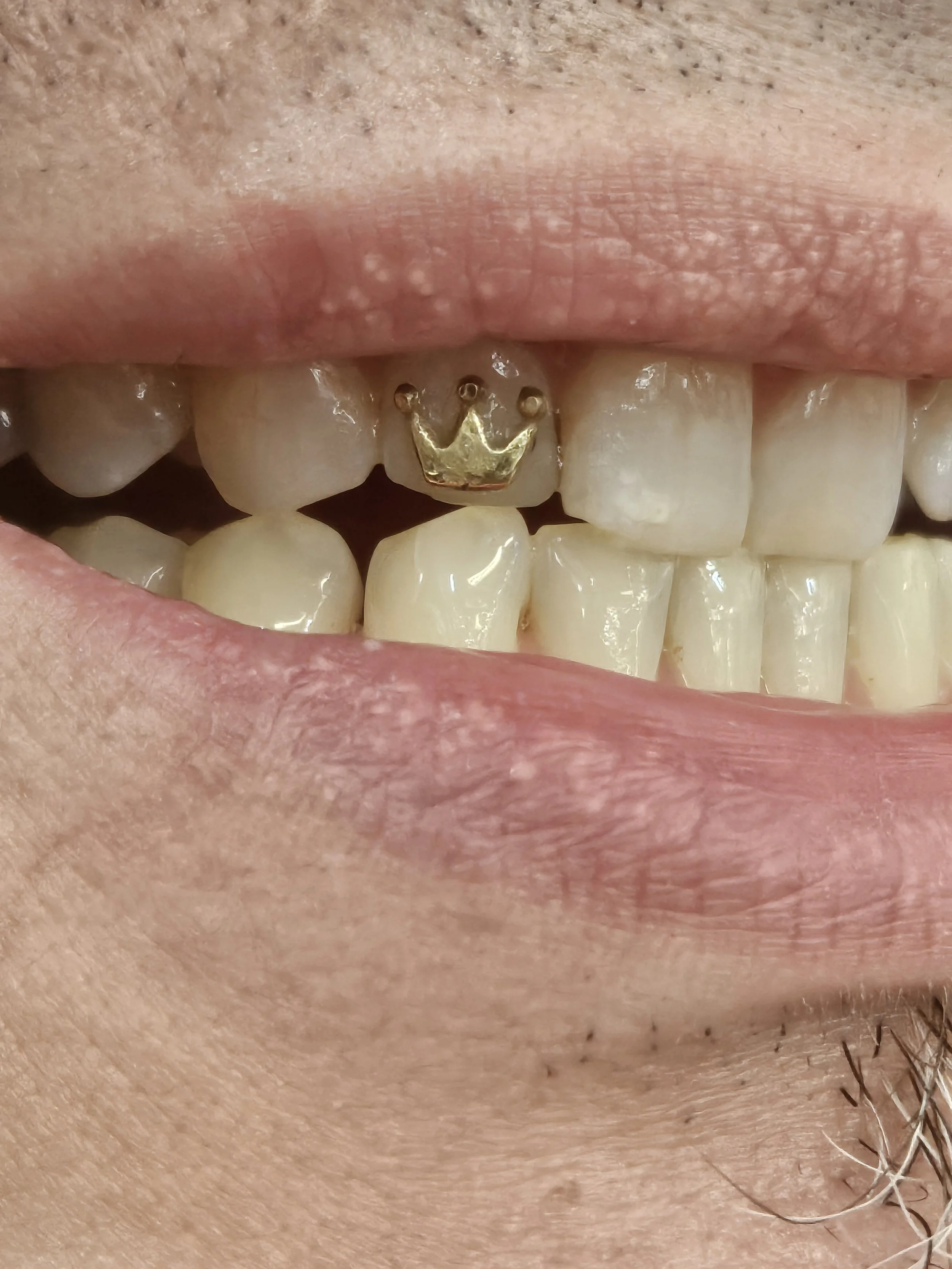 Close-up of person's mouth with a gold crown dental implant on upper front tooth.