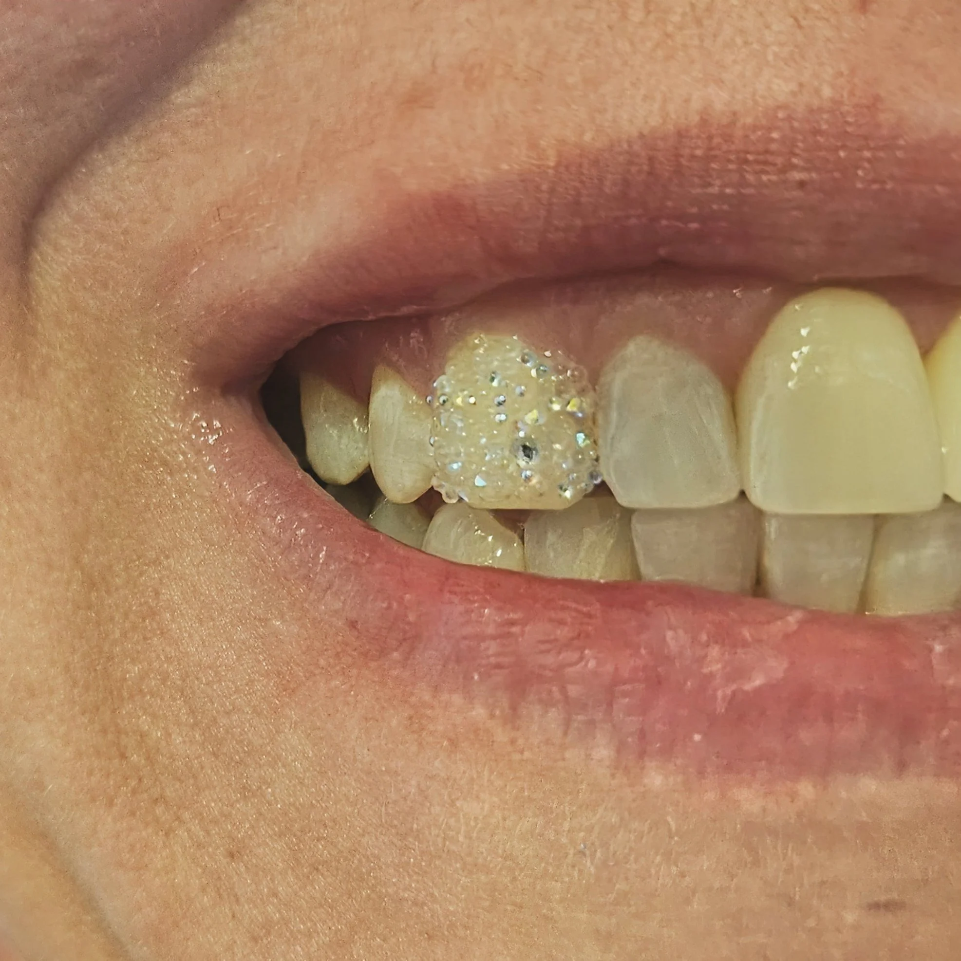 Close-up of a person’s mouth showing discolored teeth, with one tooth covered in glittery gold nail polish and rhinestones, and one tooth appearing worn or damaged.