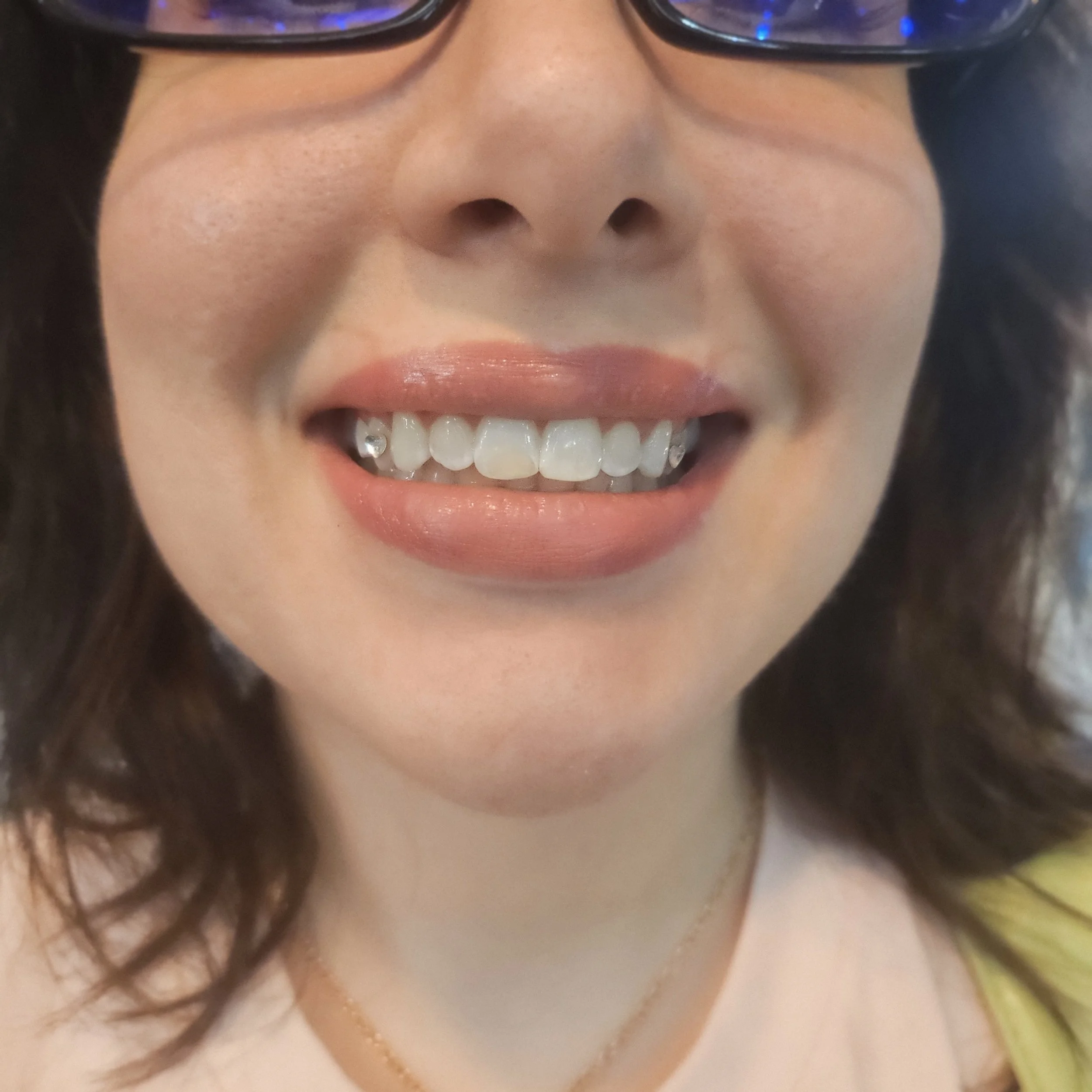 Close-up of a smiling woman wearing glasses, showing her teeth with silver braces, wearing pink lipstick.