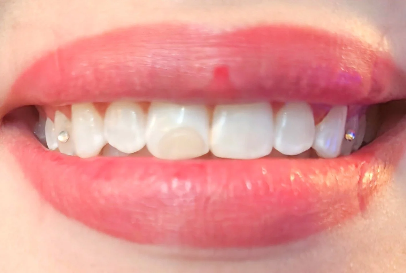 Close-up of a person's mouth showing upper and lower teeth with small decorative gems on the lateral incisors.