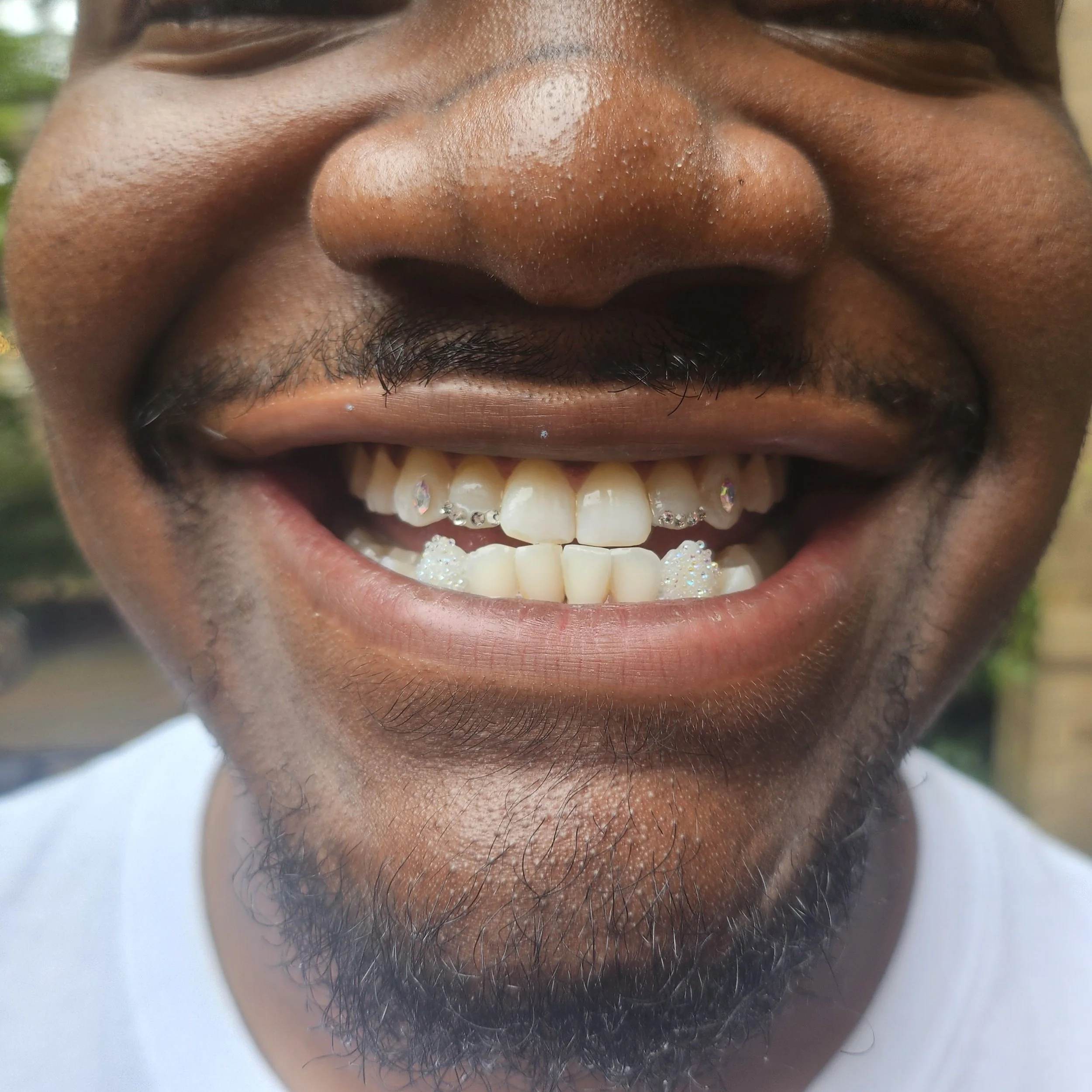 Close-up of a smiling man showing his teeth with braces and decorative rhinestones, with facial hair including a moustache and beard.
