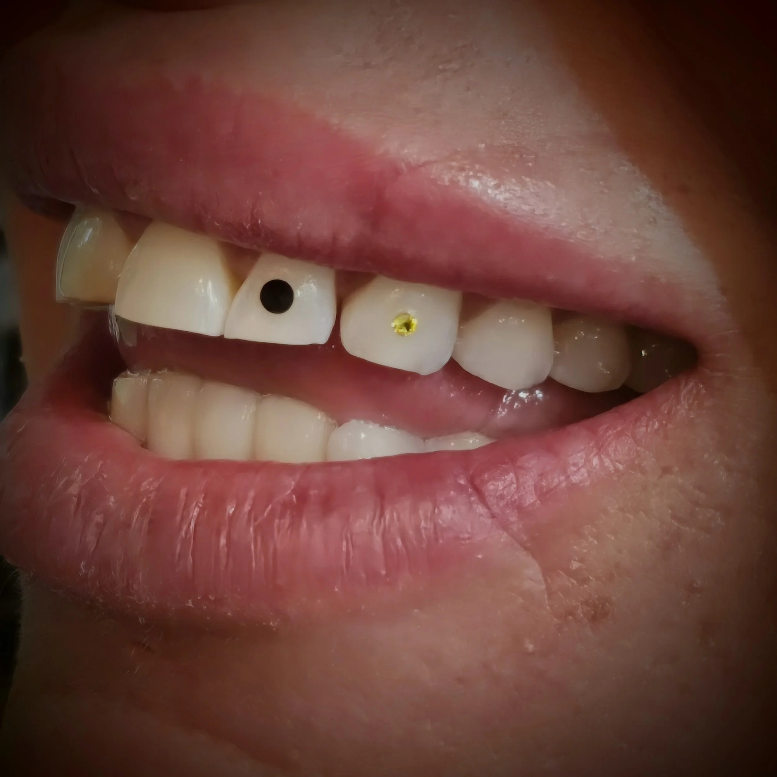 Close-up of a person's mouth with some teeth showing, including two teeth with colored stickers, one black and one yellow.