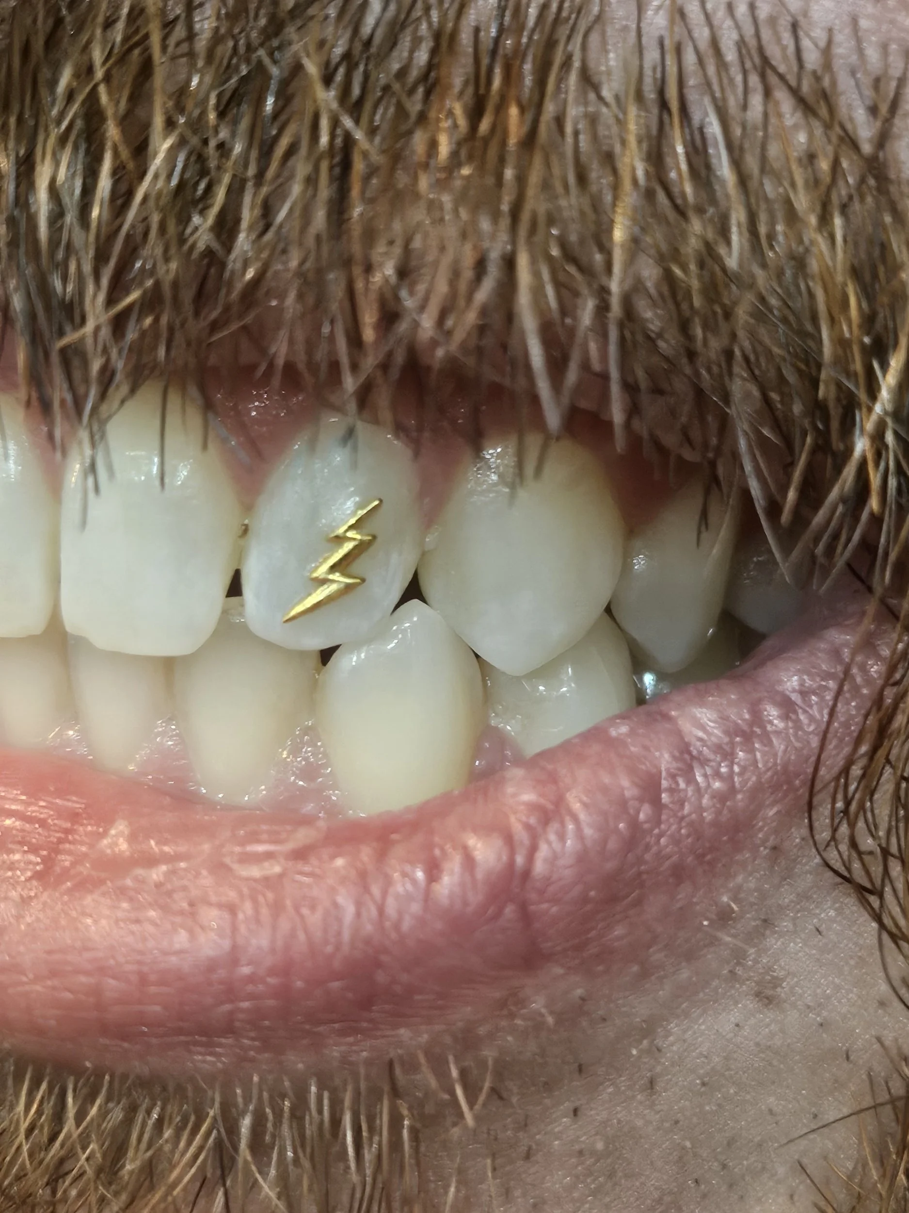 Close-up of a person's open mouth showing teeth and a small gold lightning bolt ring on one upper front tooth.