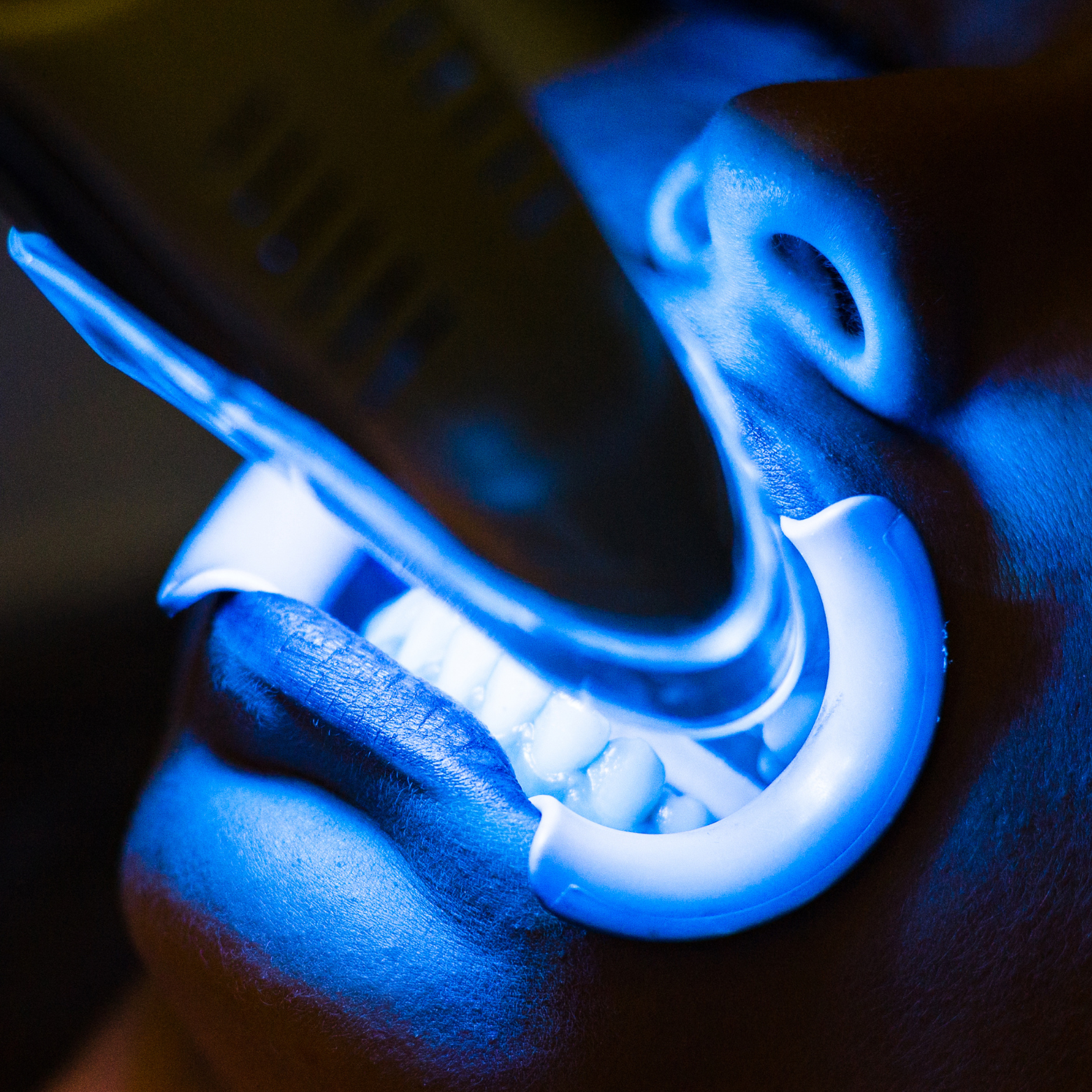 IN OFFICE TEETH WHITENING 