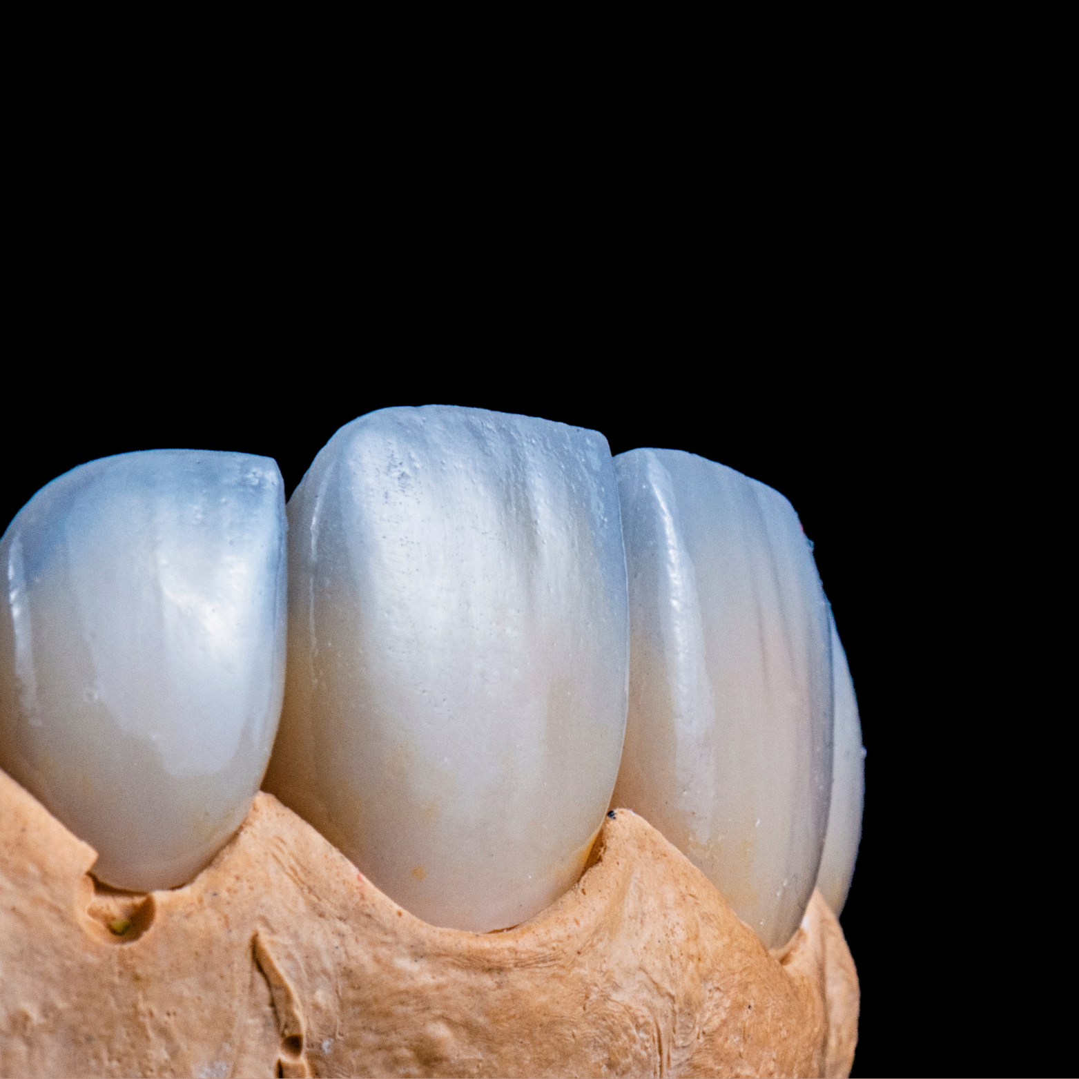CERAMIC VENEERS