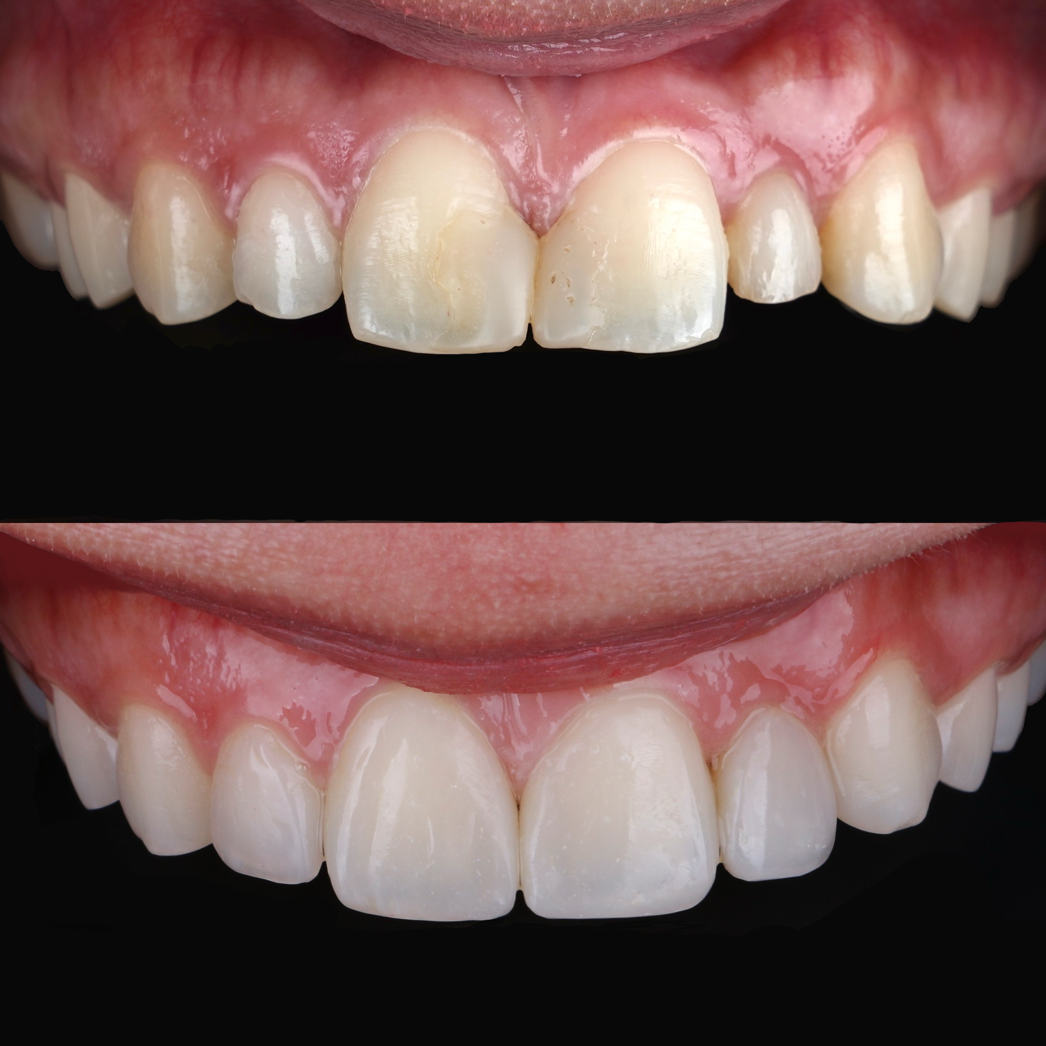 COMPOSITE VENEERS